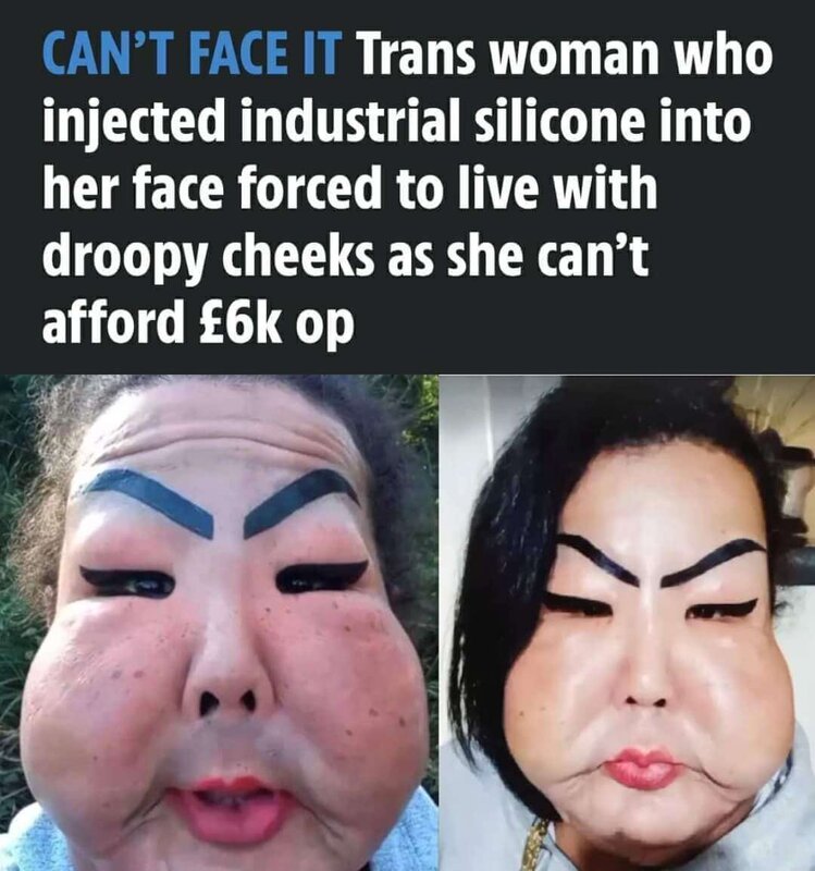 trans-cheek-injection.jpg